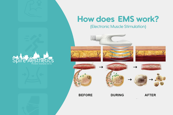 EMS treatment for post pregnancy weight loss treatment Salford Priors