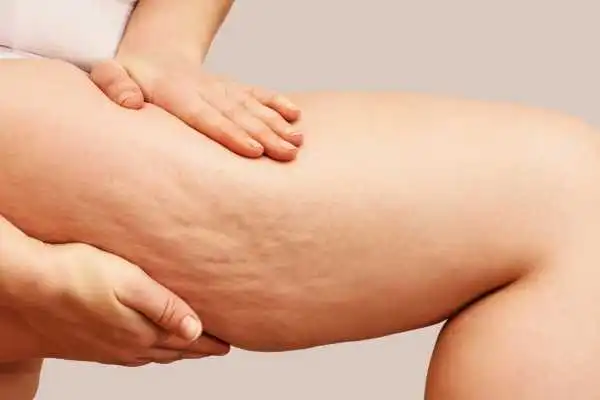 Image of woman showing leg with cellulite Salford Priors