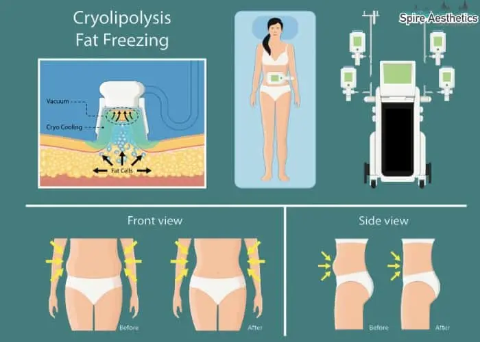 Fat freezing treatment Salford Priors benefits for competitions to remove stubborn fat deposits.