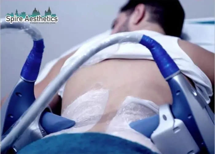 Man having fat freezing treatment done on love handles before a competitions Salford Priors to create a sculpted look.