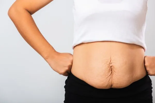 Image of a woman's stomach after weight loss with sagging skin following a gastric band Salford Priors