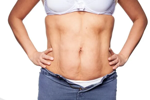 sagging skin on woman's stomach after weight loss injections Salford Priors