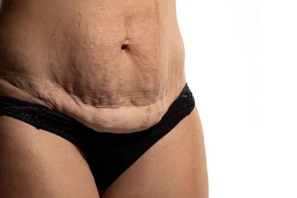 Image of womans stomach after weight loss injections Salford Priors showing saggy skin