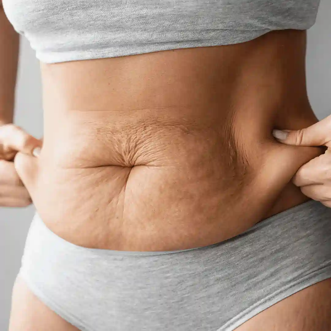 Is It Normal to Have Loose Skin After Pregnancy Salford Priors?