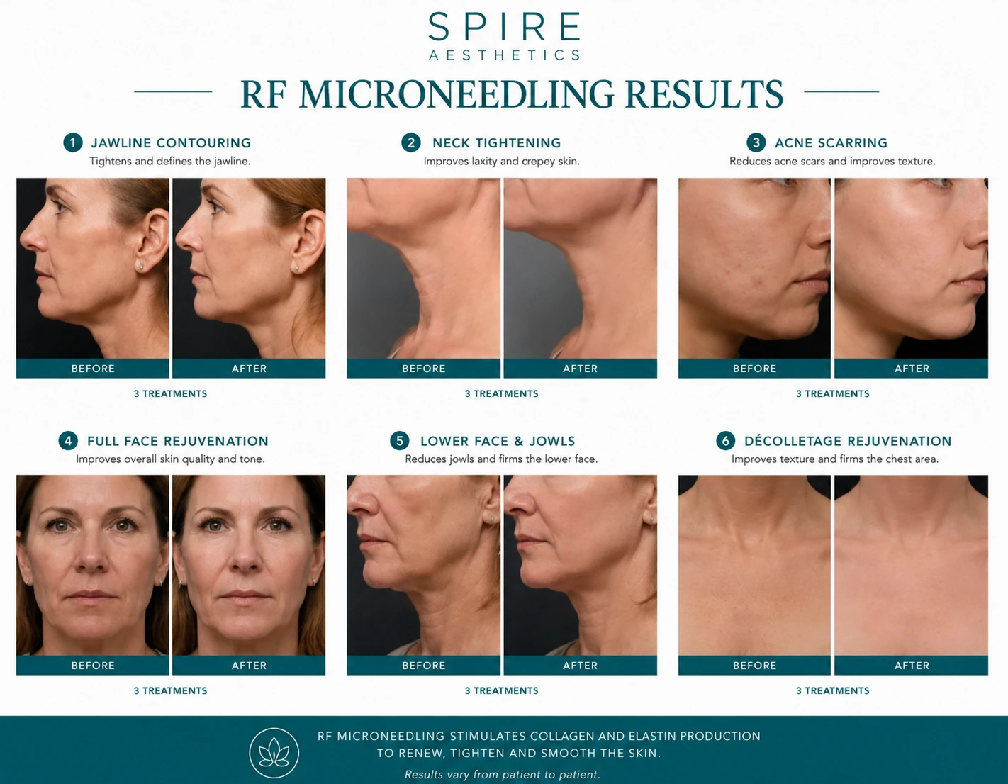 RF Microneedling Skin tightening Salford Priors results