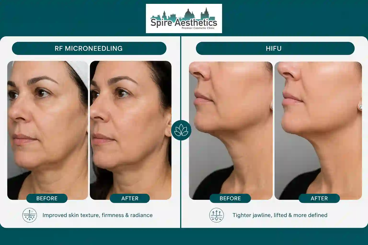 Can RF Microneedling and HIFU Be Combined Salford Priors?