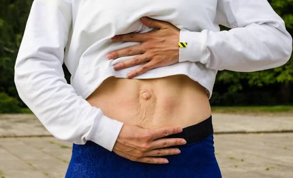When Could Diastasis Recti Be the Missing Piece of the Puzzle Salford Priors?