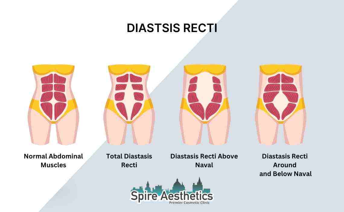 Is Non-Surgical Diastasis Recti Treatment Right for You? Common Concerns Answered Salford Priors